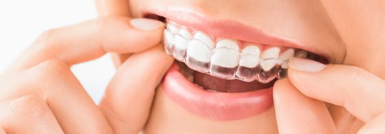 Invisalign braces over teeth