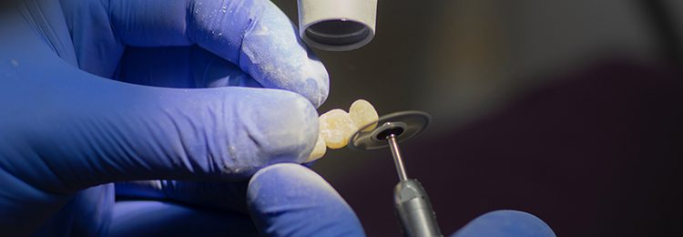 A dentist grinding a dental bridge.