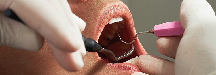 A woman holding her mouth open as it gets cleaned.