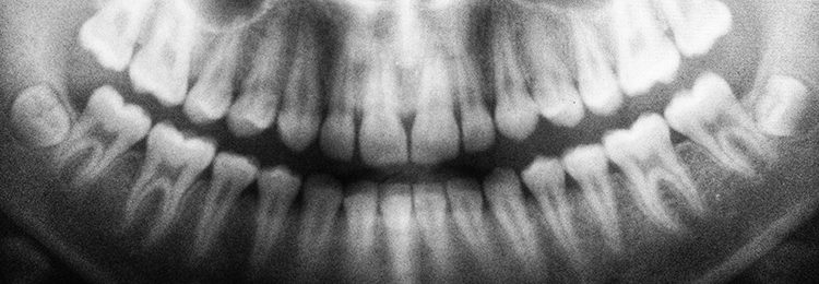 xray image of someones teeth